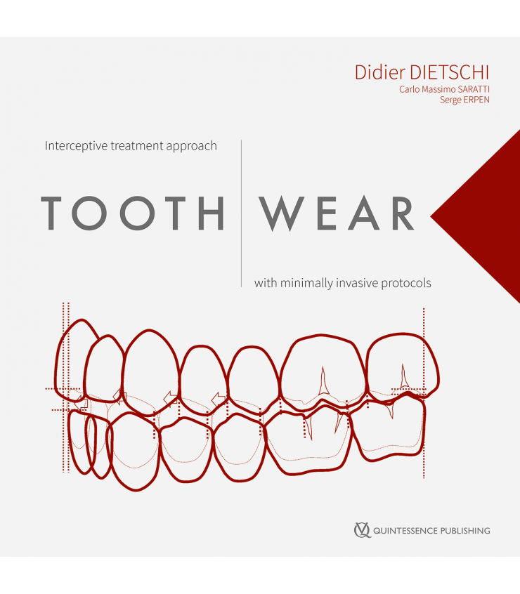 TOOTH WEAR INTERCEPTIVE TREATMENT APPROACH WITH MINIMALLY INVASIVE PROTOCOLS División Médica